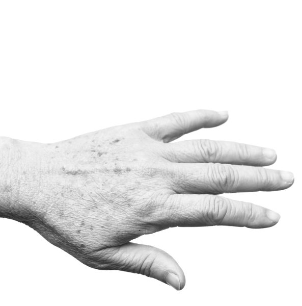 Vaatlaser/ pigmentlaser